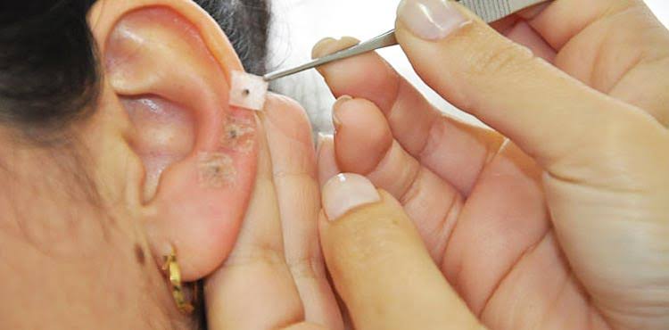 Acupuntura Auricular